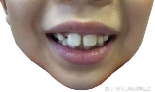 儿童睡觉张开一点嘴会变成腺样体面容吗 腺样体面容初期图片